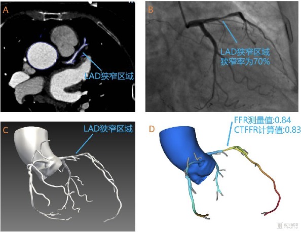 睿心医疗:完成国内首个CT-FFR领域大规模前瞻性临床试验(图2) image.png