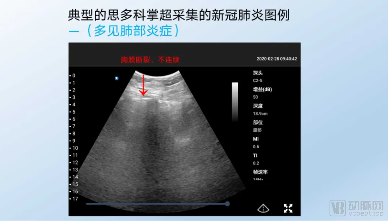 新冠疫情全球肆虐,掌上超声成为医生“第三双眼睛”(图2) 2.png