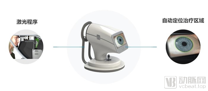 BELKIN Laser如何做到一秒治疗青光眼?(图2) 007zEkVVly1gaowf0w1a3j30rs0rs783 (1).jpg