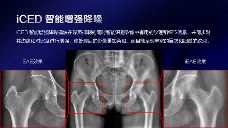 数字化X线摄影未来趋势之超低剂量化 数字化X线摄影未来趋势之超低剂量化