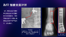 数字化X线摄影未来趋势之超低剂量化 数字化X线摄影未来趋势之超低剂量化