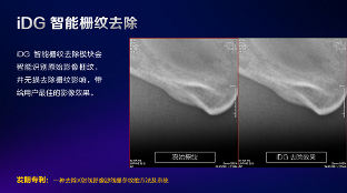 数字化X线摄影未来趋势之超低剂量化 数字化X线摄影未来趋势之超低剂量化